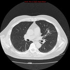 Atteinte pulmonaire active d'une granulomatose de Wegener TDM Thorax Axial Fenêtre Air Atteinte pulmonaire active d'une granulomatose de Wegener TDM Thorax Axial Fenêtre Air