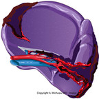 Splenic injuries splenic-injury-AAST-injury-scale Splenic injuries splenic-injury-AAST-injury-scale