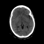 Abdominal vessels trauma, Intraperitoneal bladder rupture, Spleen infarction, Pelvic fracture Head CT, Axial plane, Soft tissue window Abdominal vessels trauma, Intraperitoneal bladder rupture, Spleen infarction, Pelvic fracture Head CT, Axial plane, Soft tissue window