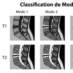 Modic: modifications des plateaux vertébraux en IRM sur discopathie dégénérative modic-classification-schema Modic: modifications des plateaux vertébraux en IRM sur discopathie dégénérative modic-classification-schema
