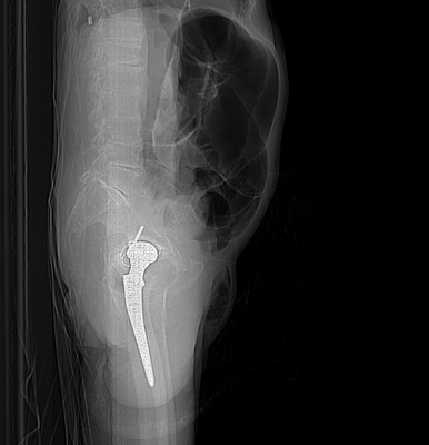 Volvulus du sigmoïde Profil couché (scout)