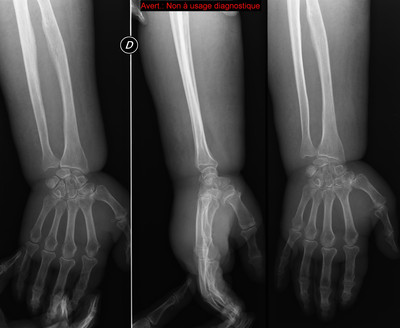 Chondrocalcinose  Radiographie du mois de mai