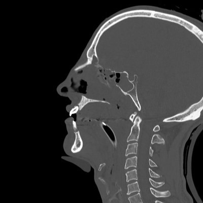 Severe cranioencephalic injuries, Carotid artery dissection, Aspiration pneumonia, Pelvic fracture Face CT, Sagittal plane, Bone window