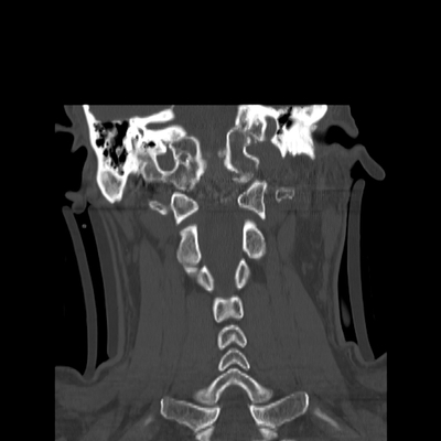 Occipital Condyle Fracture, Thoracic injuries, Hepatic trauma, Adrenal hemorrhage Cervical spine, Coronal plane, Bone window