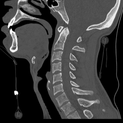 rupture de la veine rénale, hématome de la surrénale rachis cervical sag os
