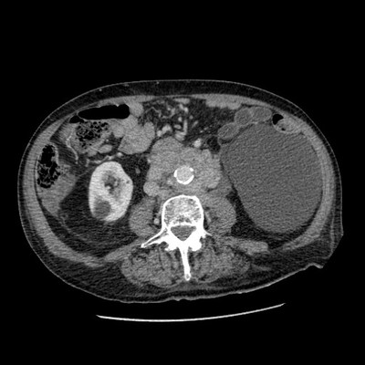 Néoplasie prostatique multimétastatique TDM axial