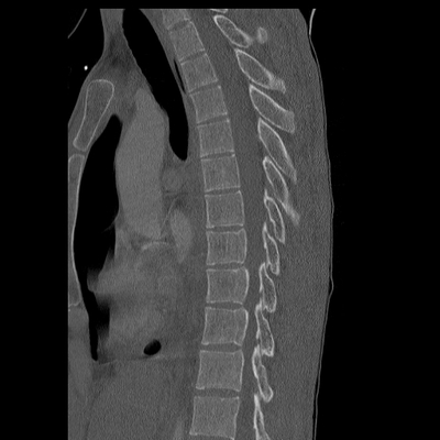 Thoracic Injuries, Subcapsular hemorrhage of liver, Pelvic injury Thoracic spine, Bone window