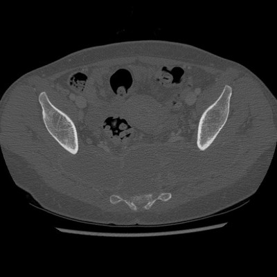 Tuberculose sacrée avec volumineux abcès Bassin os axial
