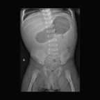 Volvulus sur malrotation (mésentère commun incomplet) ASP Volvulus sur malrotation (mésentère commun incomplet) ASP