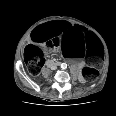 Sigmoid volvulus Axial