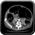 Sigmoid volvulus Axial