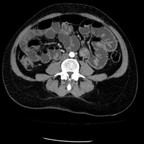 GIST Multiples. TDM Abdomen Axial Temps artériel. GIST Multiples. TDM Abdomen Axial Temps artériel.