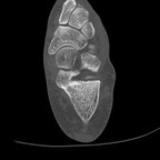 Lipome intra osseux du calcanéum Axial Os Lipome intra osseux du calcanéum Axial Os
