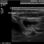 Purpura rhumatoïde échographie digestive Purpura rhumatoïde échographie digestive