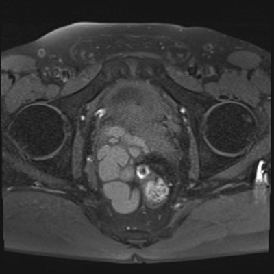 Kyste de la vésicule séminale et agénésie rénale homolatérale IRM Pelvis Axial T1 FS