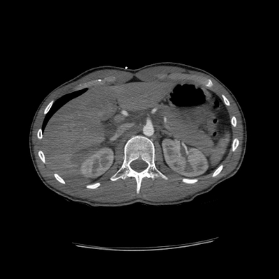 Thoracic Injuries, Subcapsular hemorrhage of liver, Pelvic injury Chest, Abdomen and pelvis, Axial plane, Arterial phase