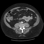 Diverticulite sigmoïdienne TDM Abdomen Pelvis Axial Portal Diverticulite sigmoïdienne TDM Abdomen Pelvis Axial Portal
