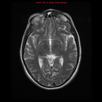 Histiocytose X langerhansienne thoracique et cérébrale IRM Crâne Axial T2 Histiocytose X langerhansienne thoracique et cérébrale IRM Crâne Axial T2