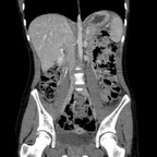 Phéochromocytome et paragangliome dans un contexte de maladie de Von Hippel Lindau TDM Coronal Phéochromocytome et paragangliome dans un contexte de maladie de Von Hippel Lindau TDM Coronal