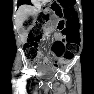 Sigmoid volvulus Coronal