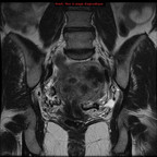 Embolisation de fibromes utérins IRM Pelvis - Pré-embolisation Embolisation de fibromes utérins IRM Pelvis - Pré-embolisation