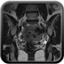 Embolisation de fibromes utérins  IRM Pelvis - Pré-embolisation