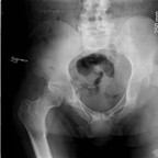 Ostéoarthrite de hanche Bassin Ostéoarthrite de hanche Bassin