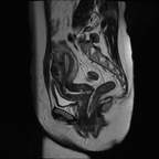 Fibrome sous muqueux antérieur droit refoulant la cavité utérine et kyste de Tailgut Sagittal T2 Fibrome sous muqueux antérieur droit refoulant la cavité utérine et kyste de Tailgut Sagittal T2