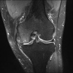 Ostéonécrose mécanique du condyle fémoral médial DP FS Coronal Ostéonécrose mécanique du condyle fémoral médial DP FS Coronal