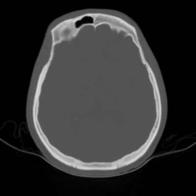 Renal vein rupture, Adrenal hemorrhage Head CT, Axial plane, Bone window