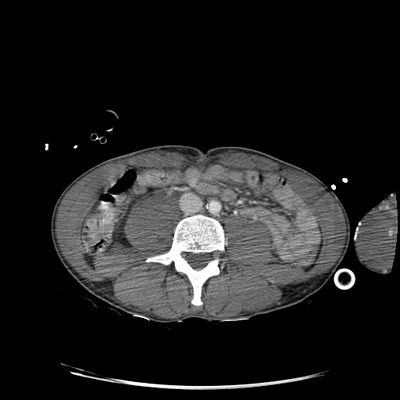 Severe cranioencephalic injuries, Carotid artery dissection, Aspiration pneumonia, Pelvic fracture Abdomen CT,  Portal venous phase, Axial plane