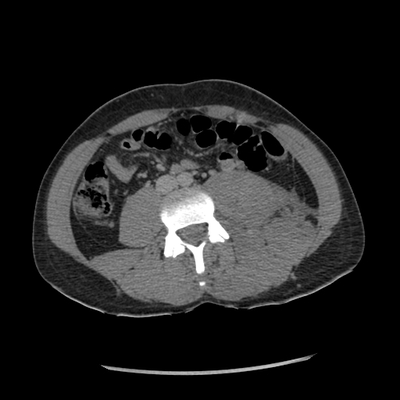 Thoracic Injuries, Spinal Injuries L5, Traumatic disc herniation Abdomen CT, Delayed phase, Axial plane