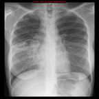Tuberculose secondaire pulmonaire active Radiographie Thorax Face Tuberculose secondaire pulmonaire active Radiographie Thorax Face