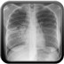 Tuberculose secondaire pulmonaire active  Radiographie Thorax Face