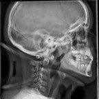 Luxation atlo-odontoïdienne avec rupture du ligament transverse Rachis cervical (Profil) Luxation atlo-odontoïdienne avec rupture du ligament transverse Rachis cervical (Profil)