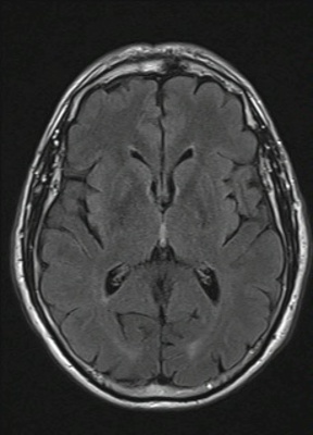 Schwannome cochléovestibulaire (neurinome de l'acoustique) FLAIR AXIAL