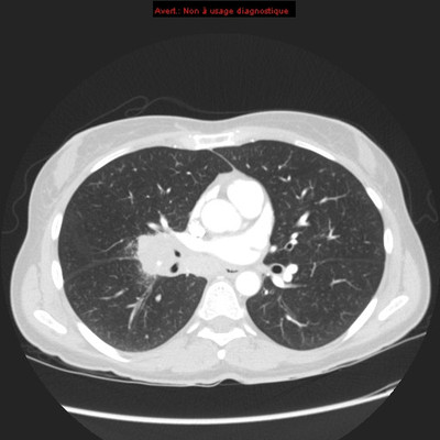 Adénocarcinome pulmonaire avec contingent à cellules claires TDM Thorax Axial Fenêtre Air