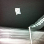 Clou métallique fixant la pulpe du doigt à une planche Radiographie Membre supérieur Profil Clou métallique fixant la pulpe du doigt à une planche Radiographie Membre supérieur Profil