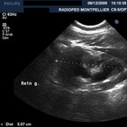 Reflux vésico-rénal gauche de grade IV Echographie rénale Reflux vésico-rénal gauche de grade IV Echographie rénale