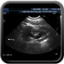 Reflux vésico-rénal gauche de grade IV Echographie rénale