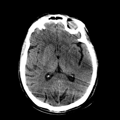 Traumatic perforation of small intestine, fracture of lumbar vertebra Head CT, Axial plane, Soft tissue window