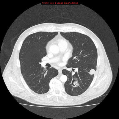 Hydatidose thoracique, hépatique et splénique avec nodules pulmonaires excavés  TDM Thorax Axial Fenêtre Air
