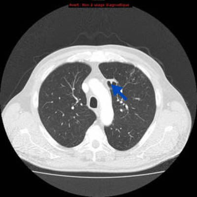 Hydatidose thoracique, hépatique et splénique avec nodules pulmonaires excavés  TDM Thorax Axial Fenêtre Air