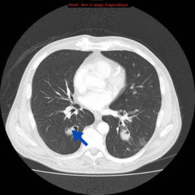 Hydatidose thoracique, hépatique et splénique avec nodules pulmonaires excavés  TDM Thorax Axial Fenêtre Air