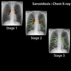 Sarcoidosis Sarcoidosis-Chest-X-ray-classification-en Sarcoidosis Sarcoidosis-Chest-X-ray-classification-en