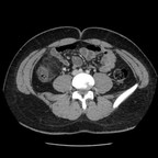Infarctus du grand épiploon TDM Abdomen Axial Temps veineux Infarctus du grand épiploon TDM Abdomen Axial Temps veineux