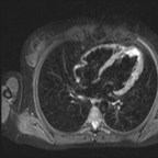 Micro-infarctus cardiaques multiples sur syndrome des anti-phospholipides T2 DB SPIR Micro-infarctus cardiaques multiples sur syndrome des anti-phospholipides T2 DB SPIR