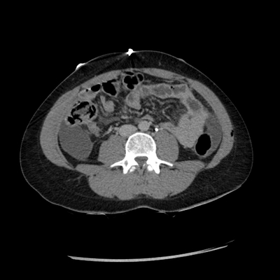 Abdominal vessels trauma, Intraperitoneal bladder rupture, Spleen infarction, Pelvic fracture Abdomen CT, Delayed phase 8min