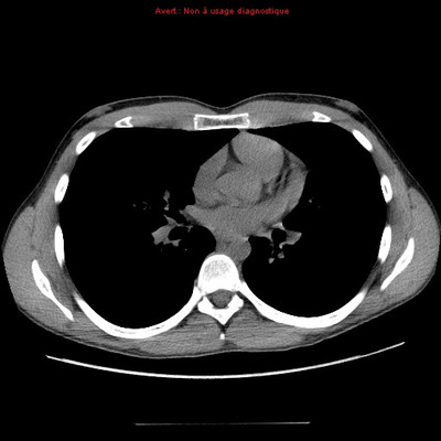 Déficit immunitaire commun variable : micronodules centrolobulaires sur bronchiolite  TDM Thorax Axial Fenêtre Tissus mous