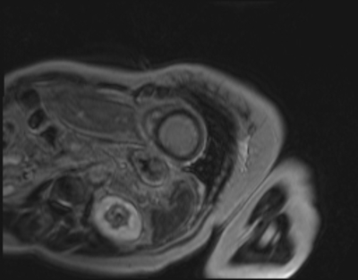 Syndrome de Tako-Tsubo - Myocardite adrénergique Rehaussement tardif - IR - Petit axe 2